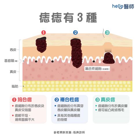 為甚麼會長痣|痣變大、痣多或長毛會變皮膚癌？認識痣的形成與原因